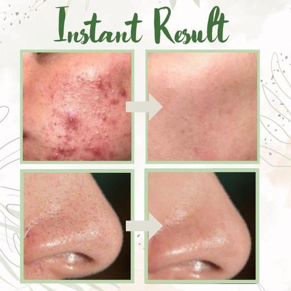 Last Day Promotion 49% OFF - 🔥Green Tea Deep Cleanse Mask
